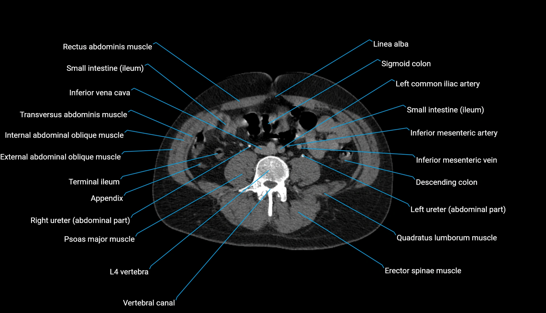 CT urogram axial cross sectional anatomy  labelled radiology image-00150.webp